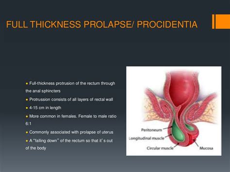 Rectal prolapse